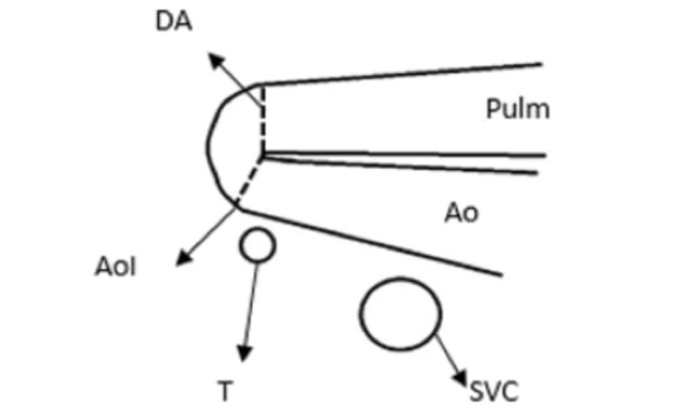 dimensiones_aorta_dibujo_2