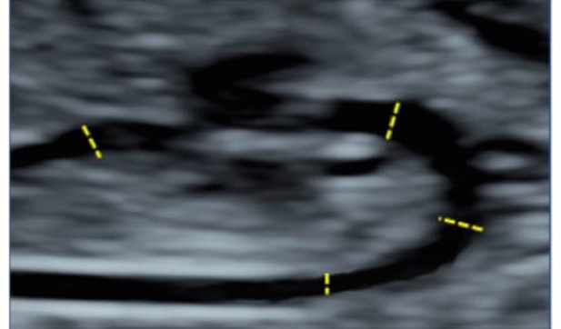 dimensiones_aorta_ultrasonido_1
