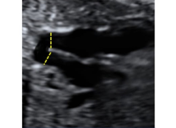 dimensiones_aorta_ultrasonido_2