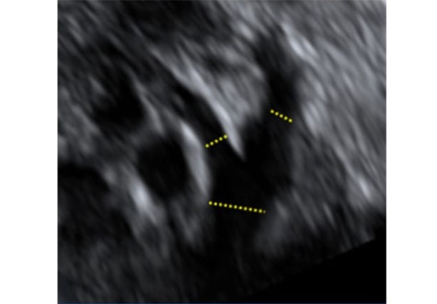 dimensiones_pulmonares_ultrasonido_1