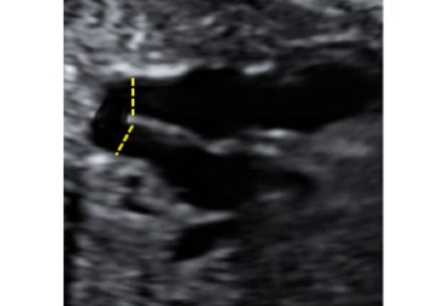 dimensiones_pulmonares_ultrasonido_2