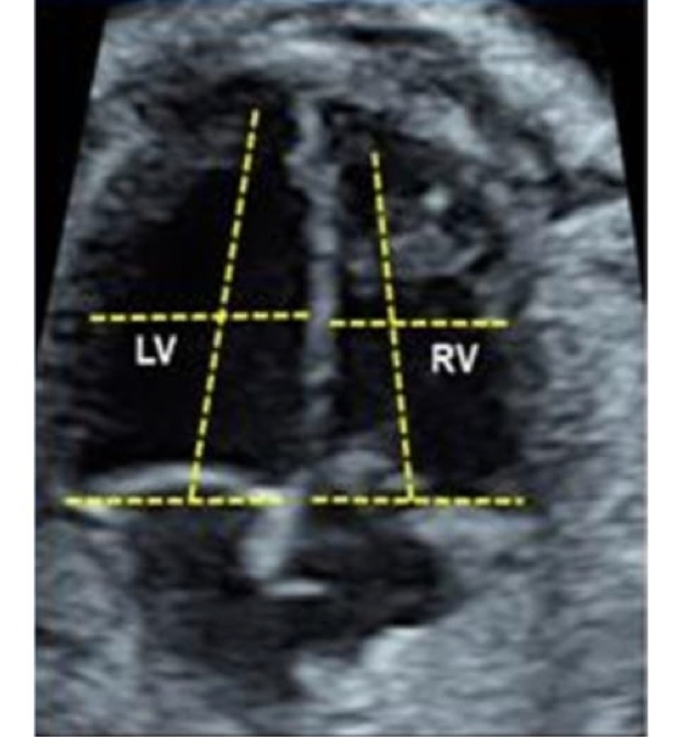 dimensiones_ventriculares_ultrasonido